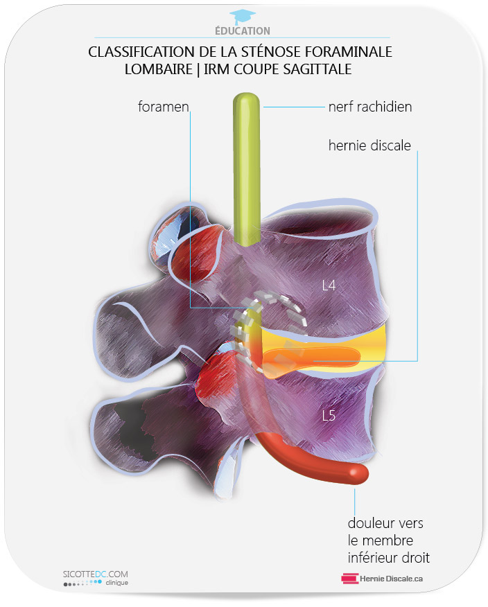 Sténose foraminale et pincement de nerf dans le foramen.