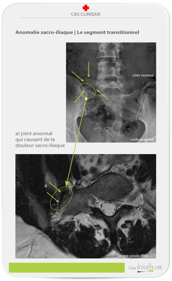 Anomalie du joint sacro-iliaque. Le segment transitionnel.