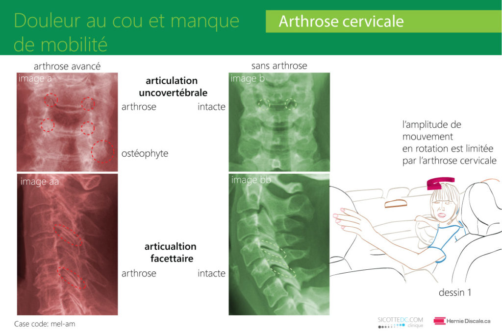 L'arthrose cervicale et le manque de mobilité. Douleur et traitement recommendations.