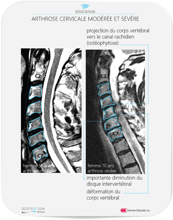 Arthrose cervicale moderée et sévère. La comparaison de l'IRM. Homme et femme. Discartrhose cervicale.