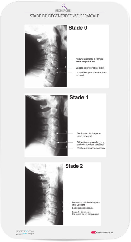 Les stades 0, 1 et 2 de l'arthrose cervicale.