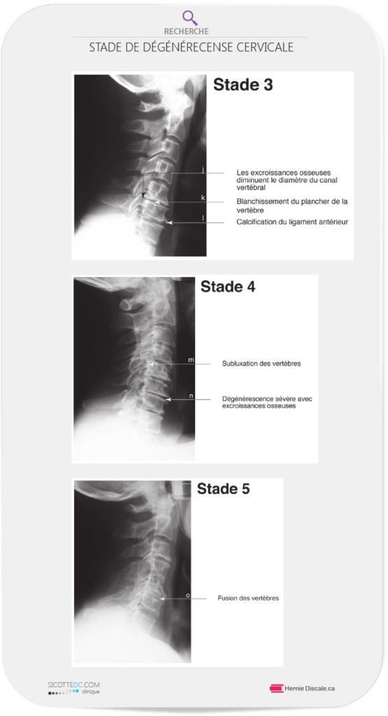 Les stades 3, 4 et 5 de l'arthrose cervicale.