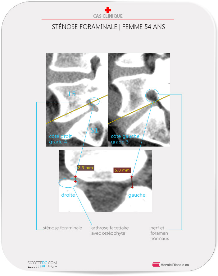 CT scan démontre de l'arthose facettaire lombaire ce qui cause une sténose foraminale L5-S1 de grade 3 et 4.
