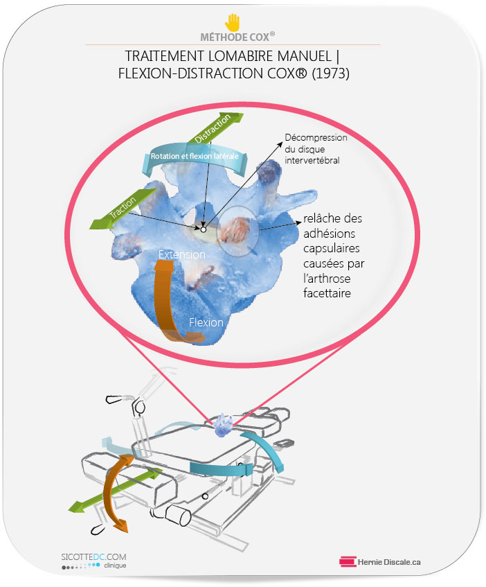 Arthrose lombaire et adhésions facettaire. La relâche des adhésions capsulaires causées par l'arthrose facettaire. Flexion distraction lombaire manuel.