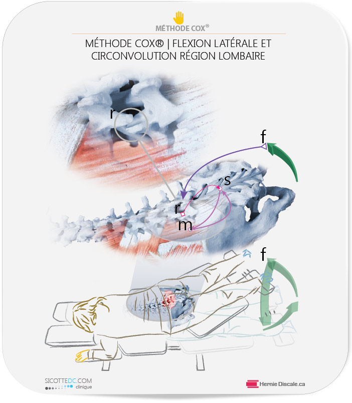 Le fonctionnement du traitement naturel Cox pour discopathie dégénérative. Les effets du spasm musculaire.