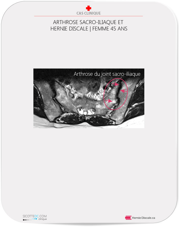 L'arthrose du joint sacro-iliaque IRM