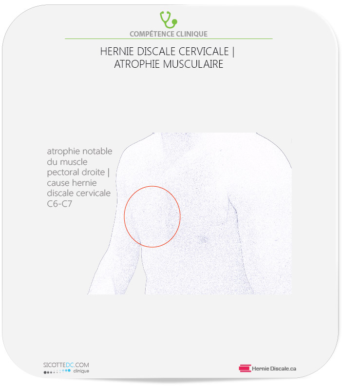 Image d'un patient qui a subie une hernie discale cervicale C6-C7. Atrophie musculaire du triceps et pectoral droite.