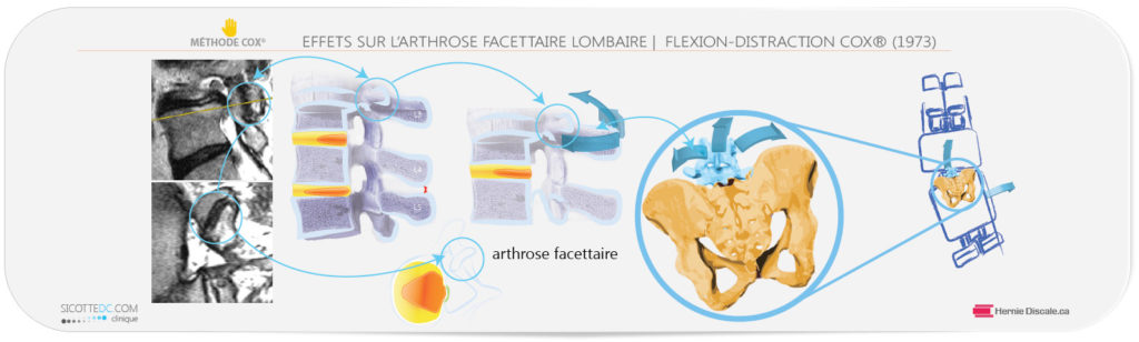 Les flexions distraction de la méthode Cox pour arthrose facettaire lombaire.