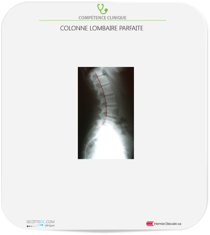 Radiographie lombaire, lordose parfaite.