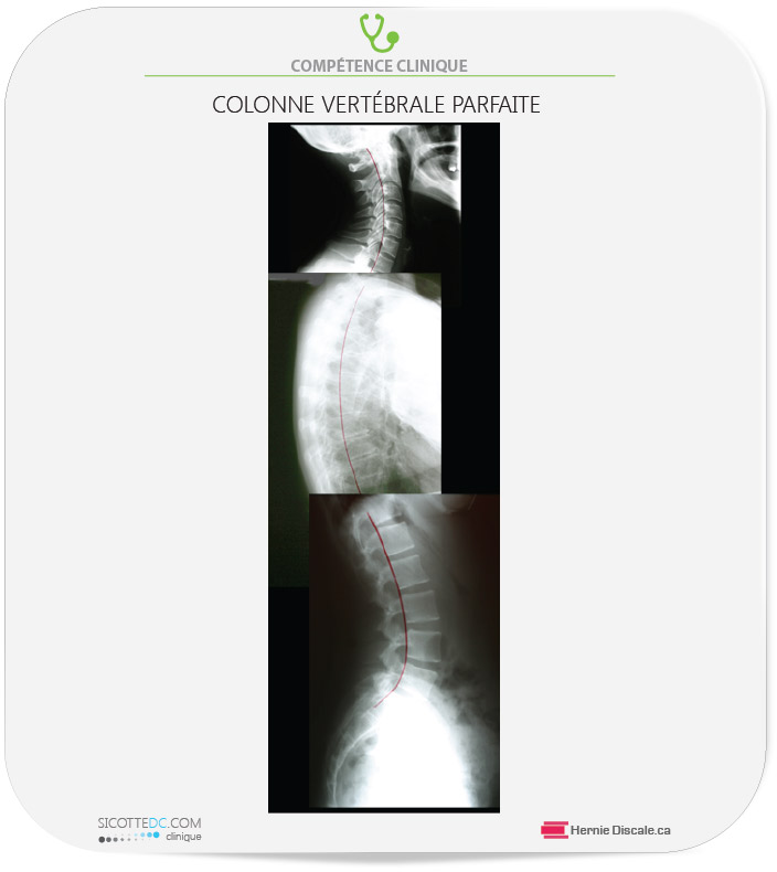 Reconstruction de la colonne vertébrale parfaite posture. Radiographie latérale.