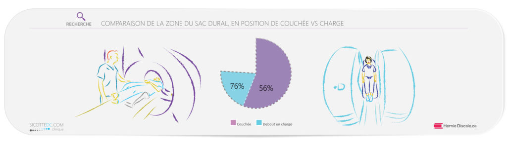 Comparaison de la dimension du sac dural IRM sténose spinale lombaire L4-L5.