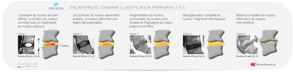 La classification Pfirrmann des disques intervertébrale lombaire.