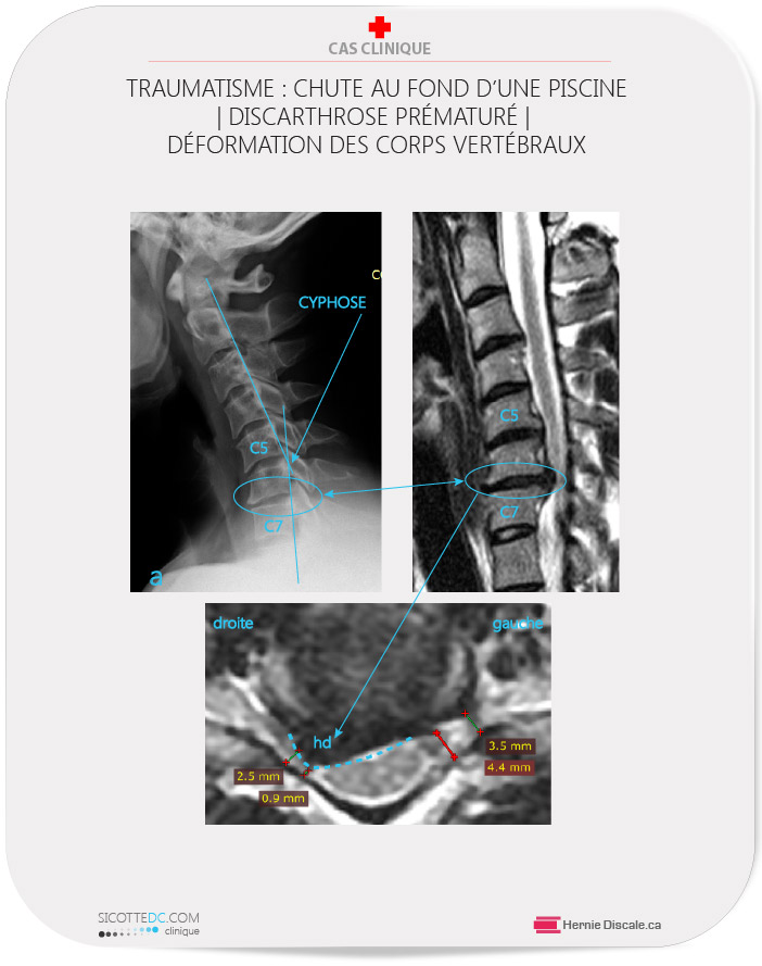 Discarthrose cervicale. La cause chute sur le front (tête). Dégénéresence prématurée de la colonne cervicale.