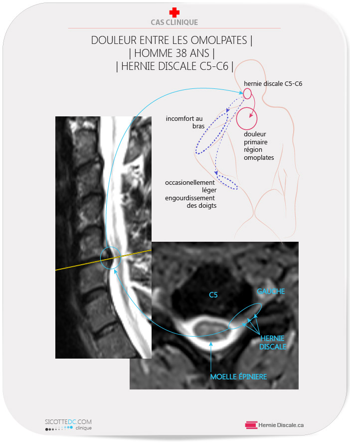 Patient avec douleur entre les omoplates. La cause une hernie discale cervicale C5-C6. Le traitement naturel : Méthode Cox® flexion distraction.