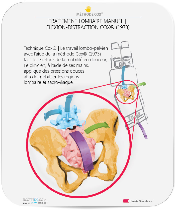Douleur sacro-iliaque traitement naturel avec la méthode Cox®