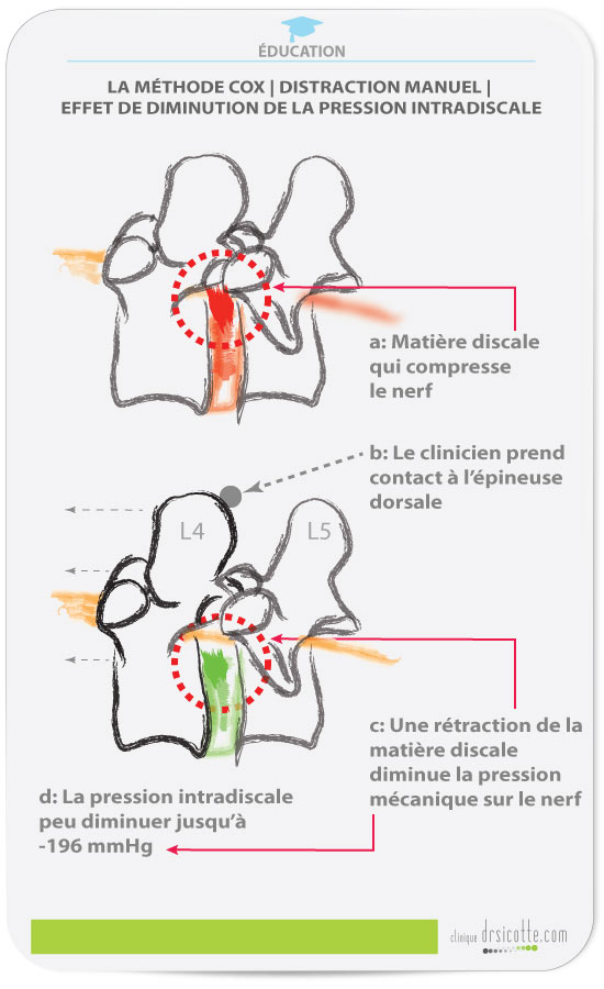 Les effets de la méthode Cox sur la pression intradiscale et la resorption de la matiere discale.