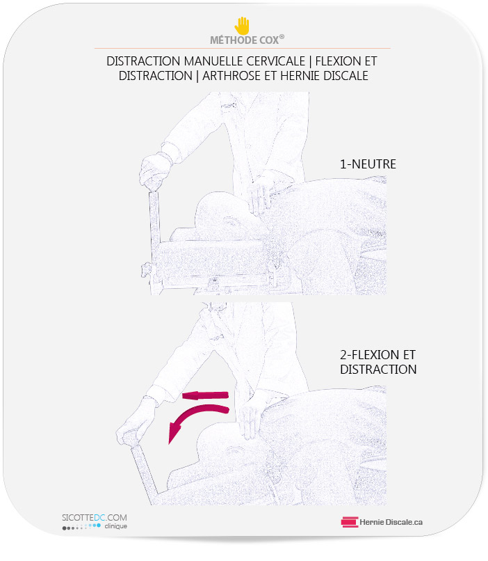 La flexion distraction méthode Cox pour arhtrose cervicale et hernie discale.