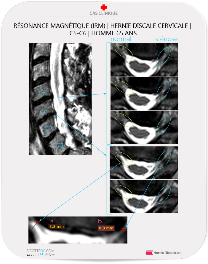 Hernie discale cervicale C5-C6. Homme de 56 . Analyse IRM imagerie par resonance magnetique.