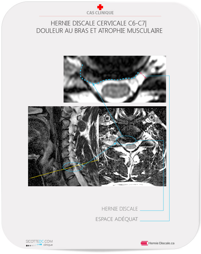 Hernie discale cervicale qui cause une atrophie musculaire au triceps et pectoral droite.