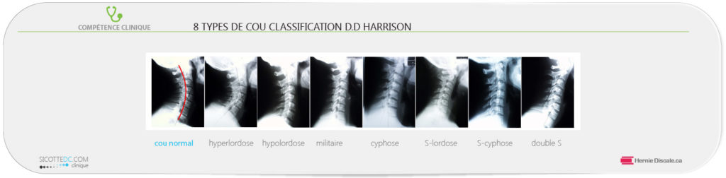 Huit types de cou courbe cervicale.