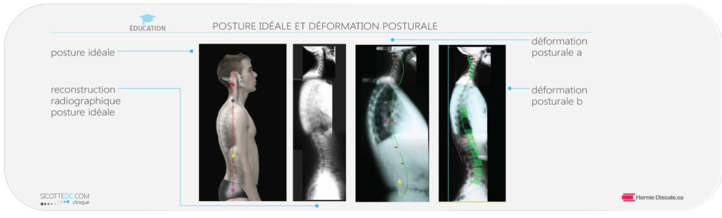 Reconstruction de la posture idéale. Radiographie et deformation.