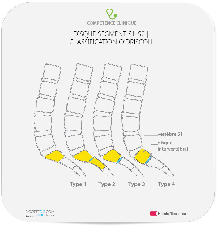 La morphologie du disque S1-S2 lors d'une anomalie sacro-iliaque accompagné d'une segment transitionnel.