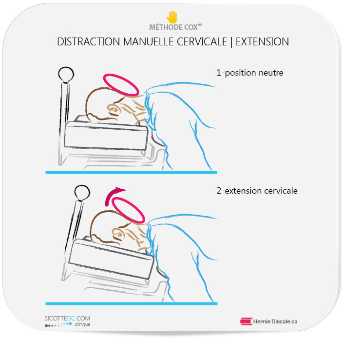 Extension cervicale pour patient qui souffre discarthrose cervicale.