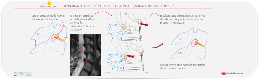 Example de decompression avec la méthode Cox pour la sténose spinale et foraminale.