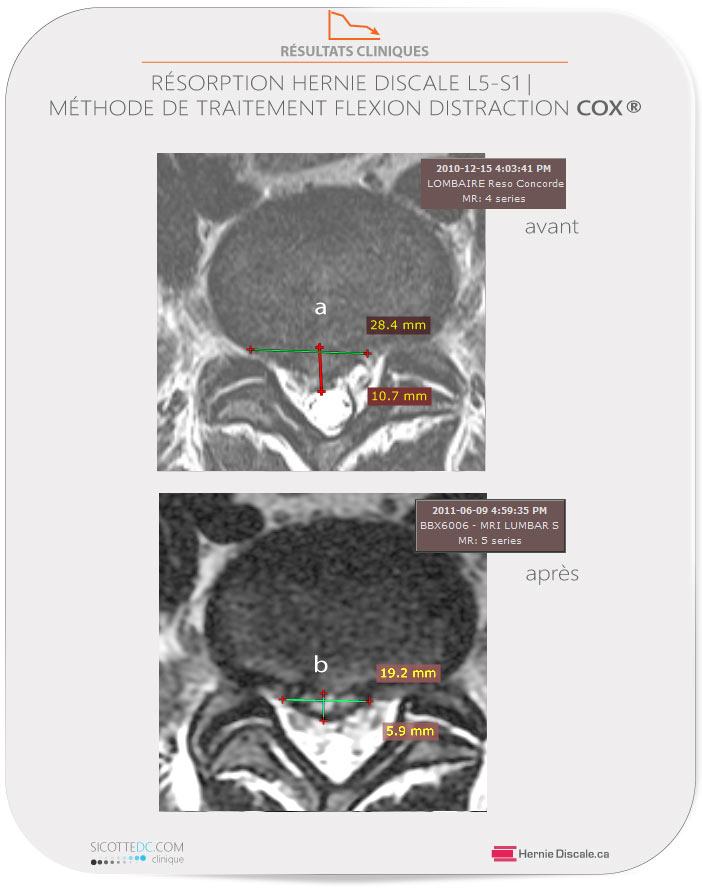 Images axiales démontrant la résorption d'une hernie discale lombaire à L5-S1.