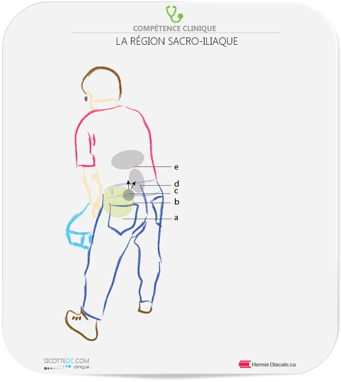 Symptômes sacro-iliaque localisation de la douleur