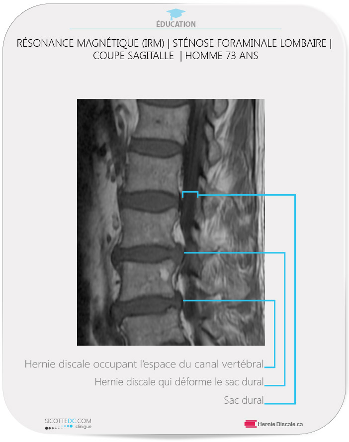 IRM - MRI Axial - Hernie Discale L4-L5. Résonance magnétique (IRM)  | example de sténose foraminale lombaire coupe sagitalle