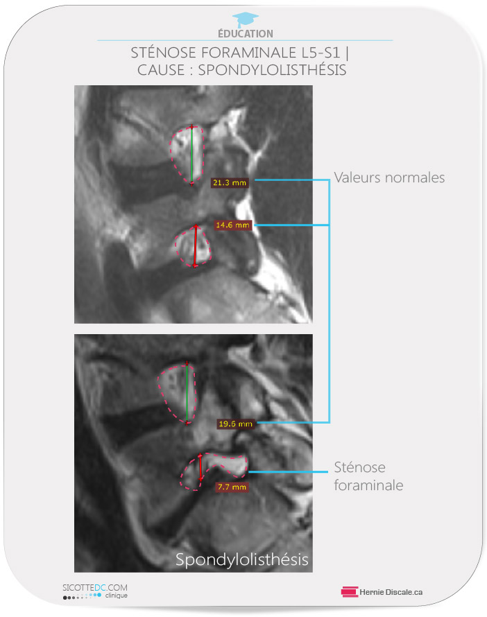 Une sténose foraminale lombaire causer par une spondylolisthésis lombaire L5-S1