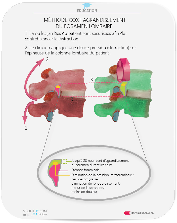La sténose foraminale effet des distractions Cox.