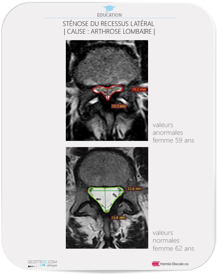 La sténose du récessus causée par arthrose facettaire lombaire.