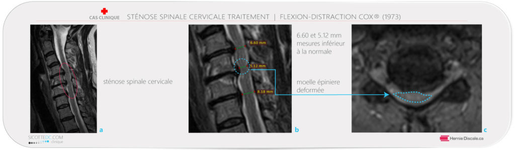 Position neutre IRM cervicale stenose spinale cervicale sévère dimension du canal.