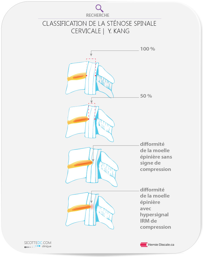 La classification de la sténose spinale cervicale de Y Kang.