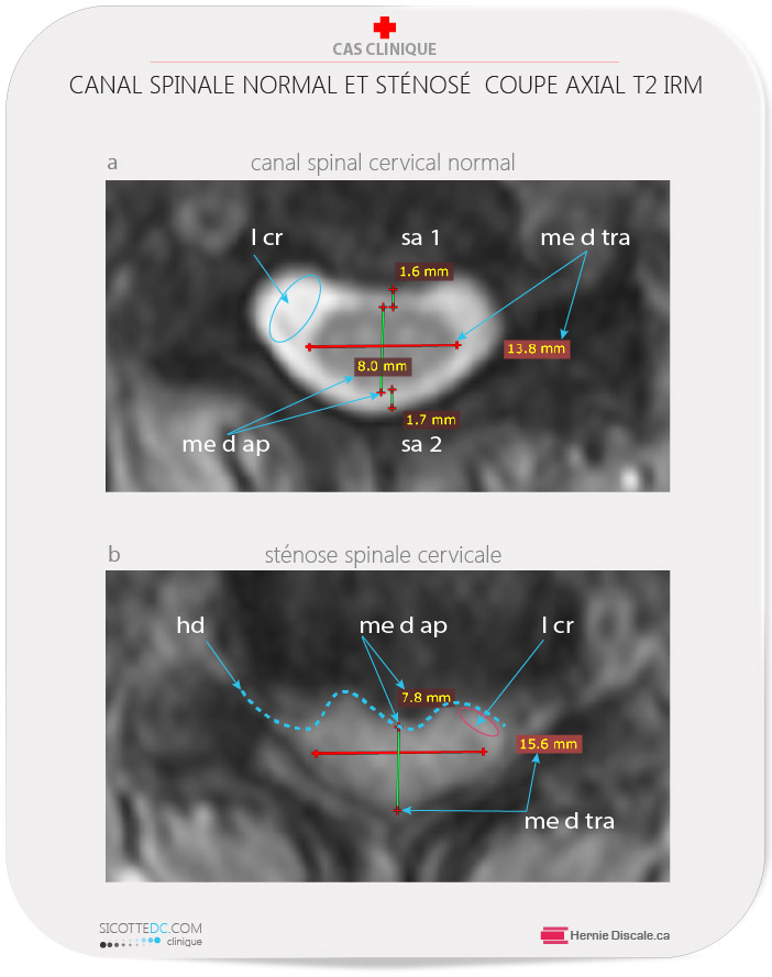 Canal spinal cervicale normale et sténosé. Une coupe axiale.