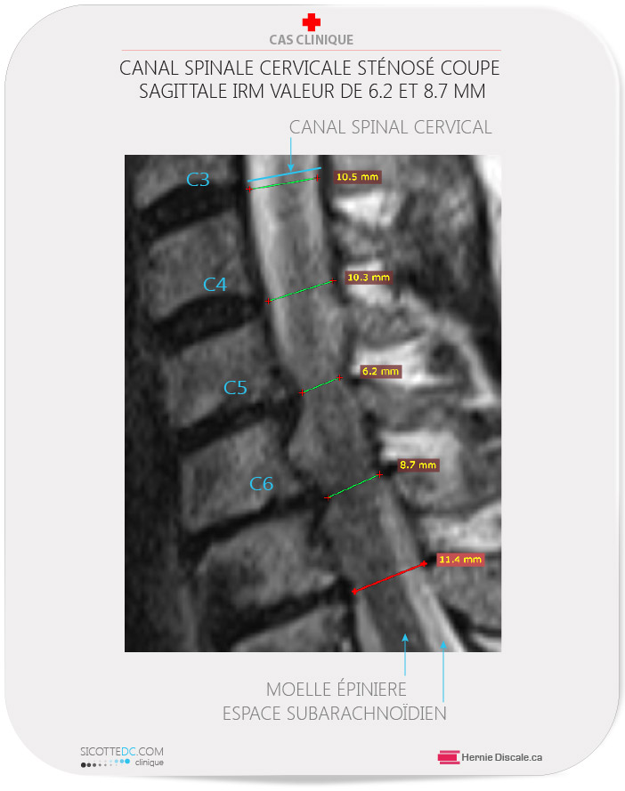 Le canal spinal cerivcale sténosé. Coupe sagittale IRM .