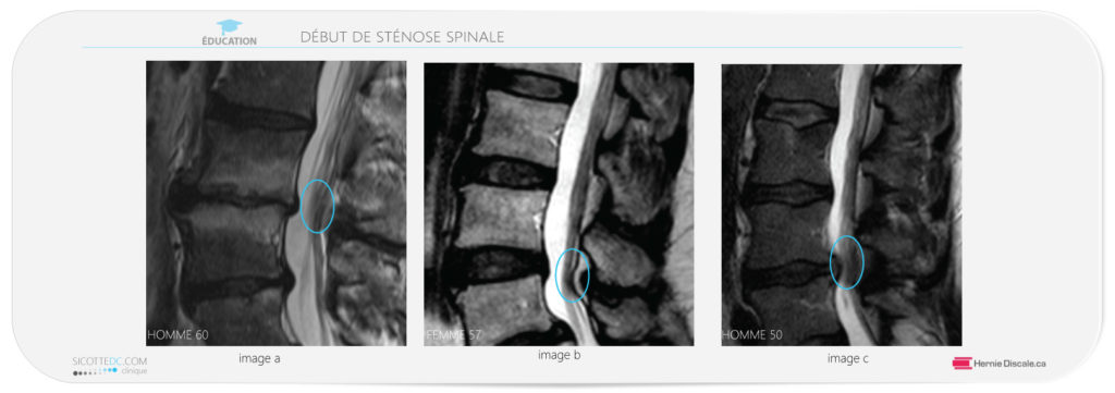 Début de sténose spinale lombaire.
