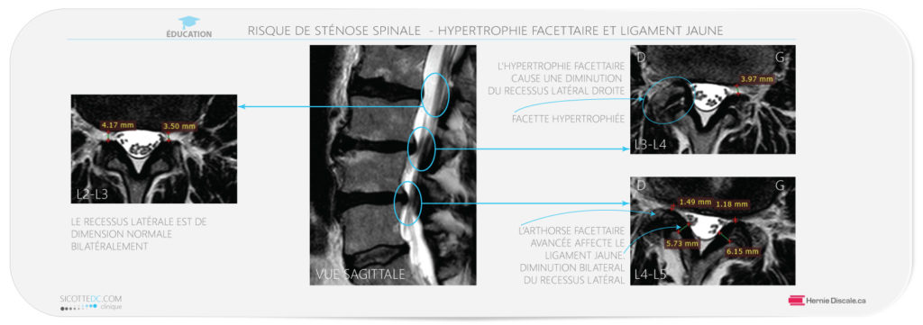 Hypertrophie du ligament jaune et facette. Contribution à la sténose spinale lombaire.