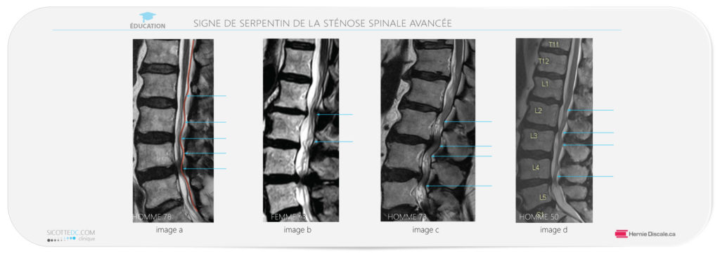 La sténose spinale lombaire sévère signe IRM.
