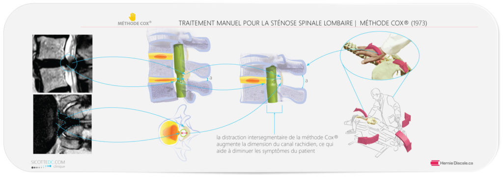 Le traitement de la sténose spinale lombaire avec la méthode Cox®.