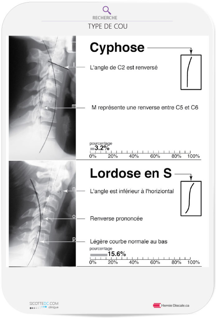 Le cou cervicale cyphose et lordose en S.
