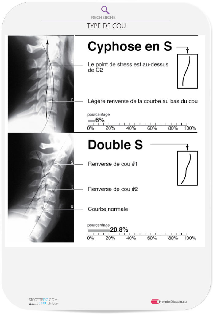 Le cou cervicale cyphose en S et double S.
