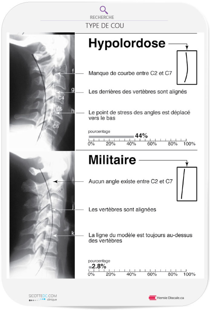Le cou cervicale hypolordose et militaire.