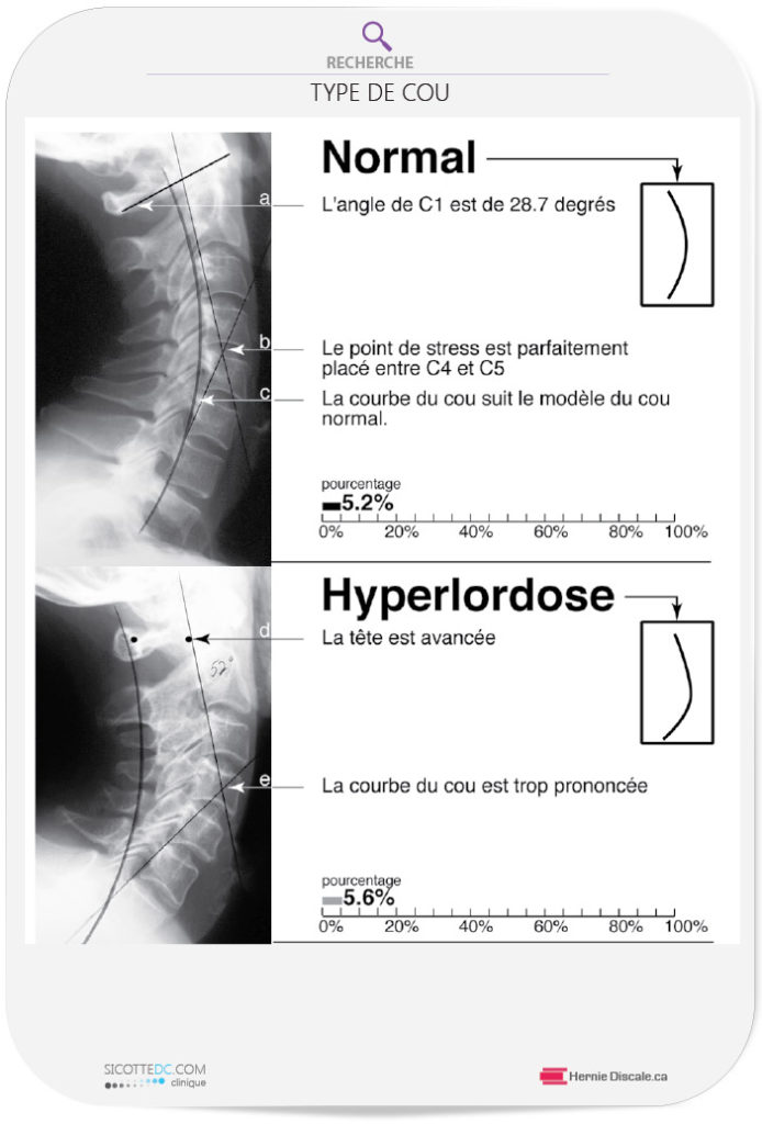 Le cou cervicale normale et le cou hyperlordose.